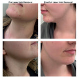 Laser Hair Reduction