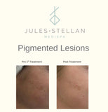 Photofacial
