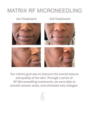 RF Microneedling