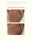 Photofacial