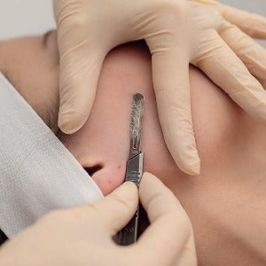 Dermaplaning