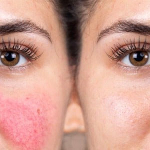 Diffuse Redness/Broken Capilleries