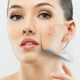 Acne Scar Treatment