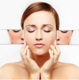 Diffuse Redness/Broken Capilleries