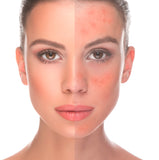Diffuse Redness/Broken Capilleries