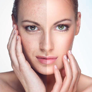 Photofacial