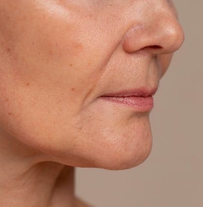 Nose Vein Treatment