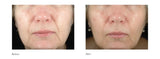 Skin Resurfacing