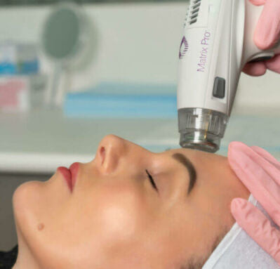 RF Microneedling