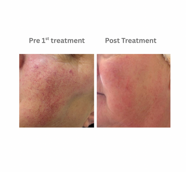 Diffuse Redness/Broken Capillaries – Jules + Stellan Medispa