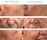 RF Microneedling