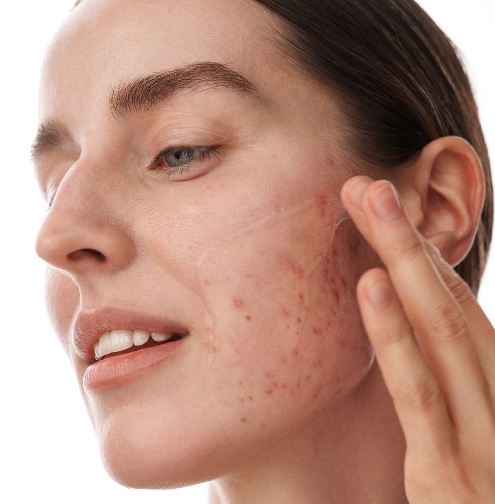 Acne Scar Treatment