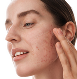 Acne Scar Treatment