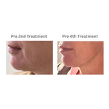 RF Microneedling