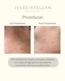 Photofacial