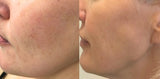 RF Microneedling