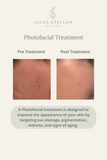 Photofacial