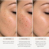 Photofacial
