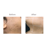 Laser Hair Reduction