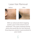 Laser Hair Reduction
