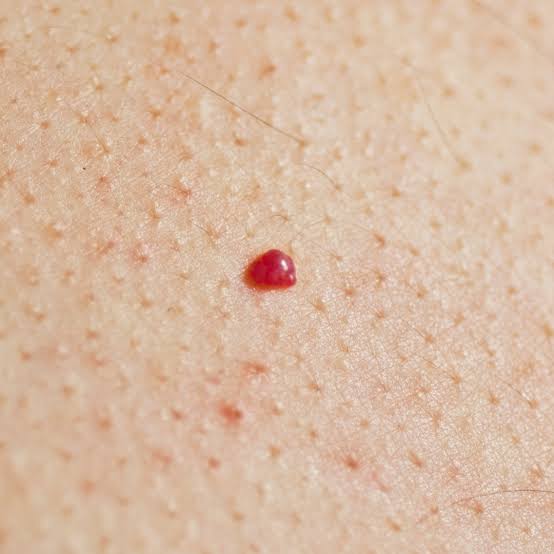 Cherry Angiomas
