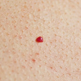 Cherry Angiomas