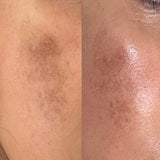 RF Microneedling