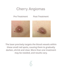 Cherry Angiomas