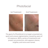 Photofacial