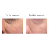 Skin Resurfacing