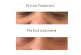 RF Microneedling