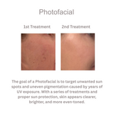Photofacial