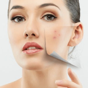 Acne Scar/Wrinkle Treatment