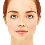 Acne Scar/Wrinkle Treatment