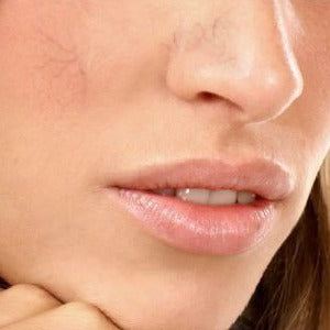 Nose Vein Treatment